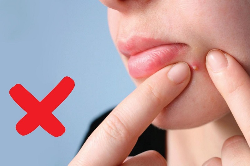 Có nên tự nặn mụn tại nhà không? Những điều cần biết để chăm sóc da đúng cách